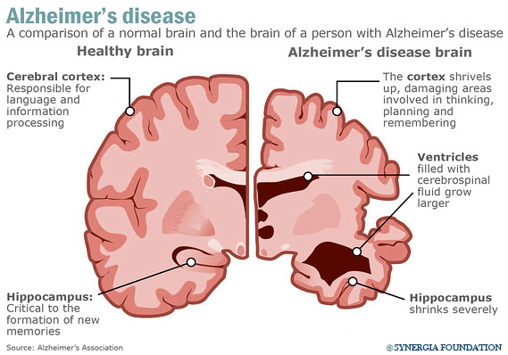 https://www.fda.gov/news-events/press-announcements/fda-grants-accelerated-approval-alzheimers-drug
