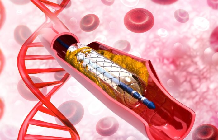 stent